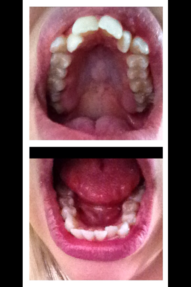 Making each minute count I got my braces off!! (Before & After Pictures!)