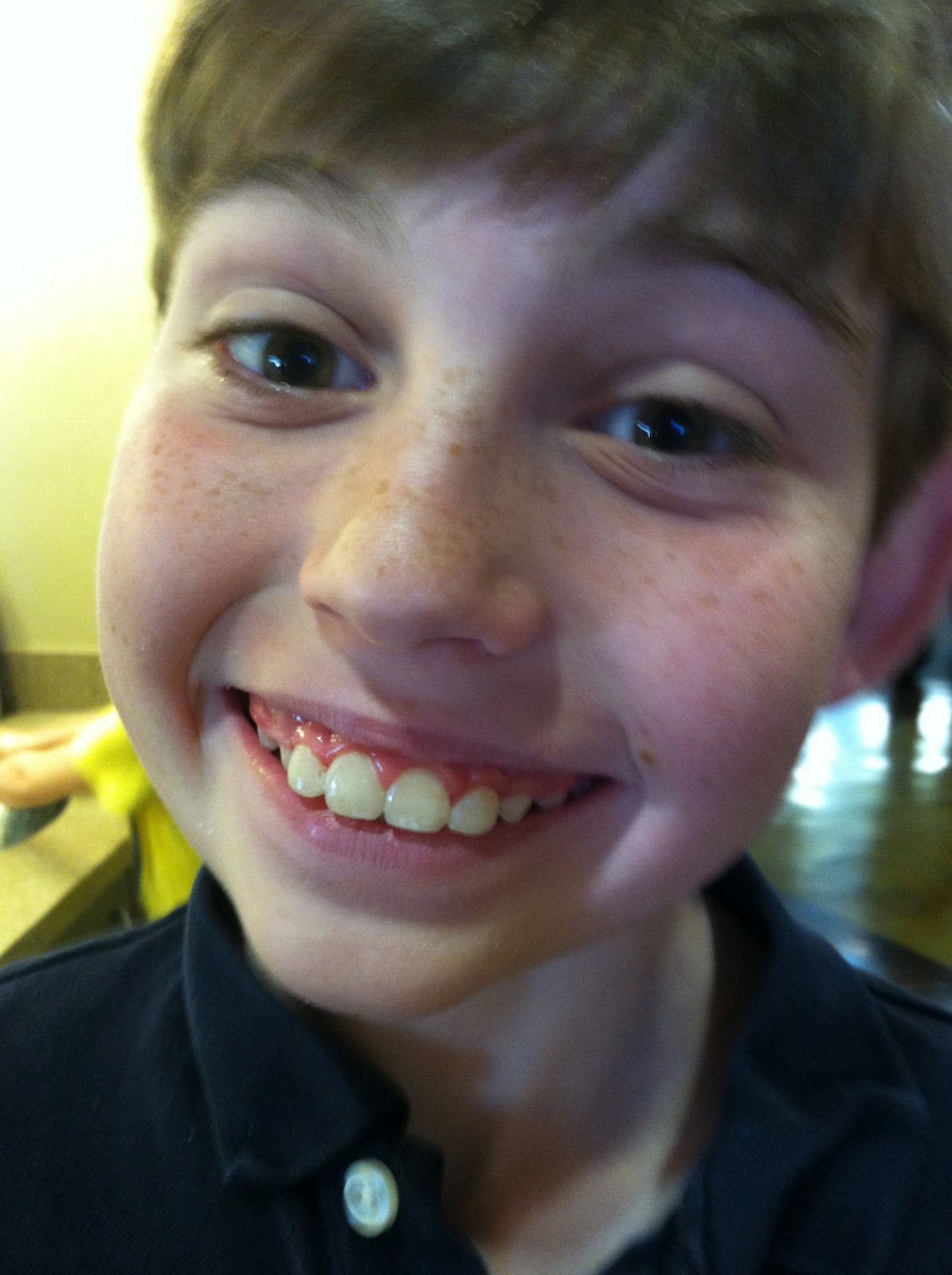 Looking Up The Braces Are Off!!!