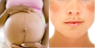 Gel de creme antes e depois de descoramento