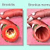 Obat Bronkitis | Pengobatan Herbal Bronkitis | Cara Mengobati Bronkitis thumbnail