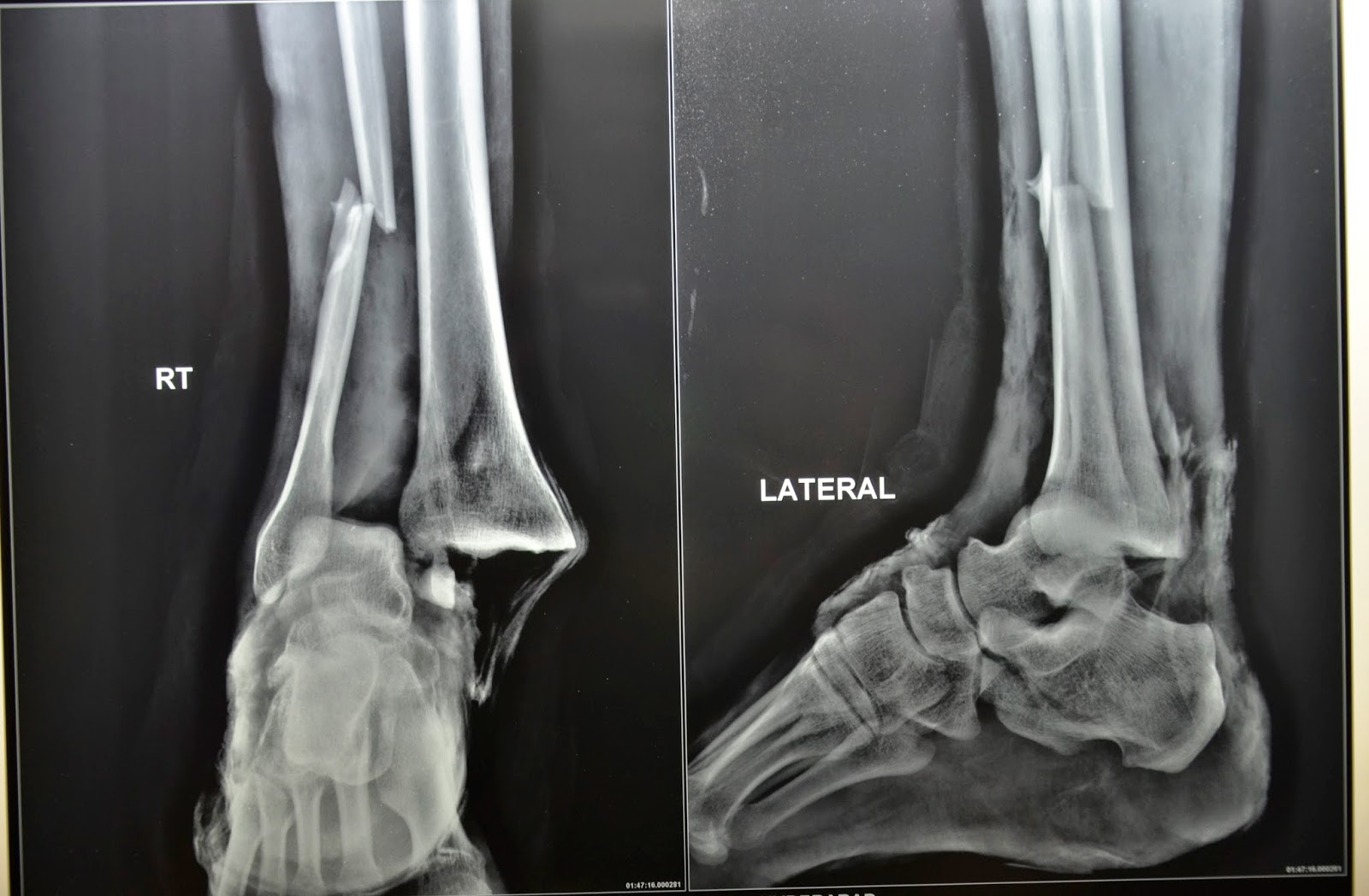 OPEN ANKLE JOINT FRACTURE DISLOCATION DEBRIDEMENT FREE GRACILIS