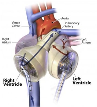 France implants its first artificial heart