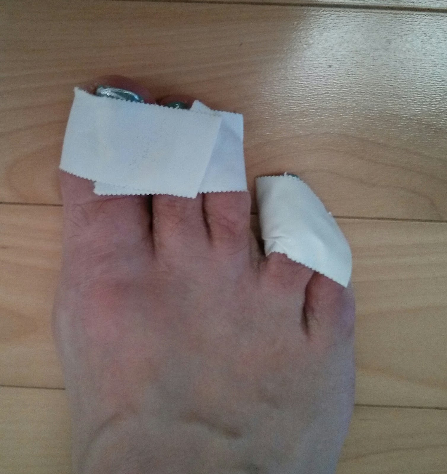 50 is the new 30 Morton's Neuroma