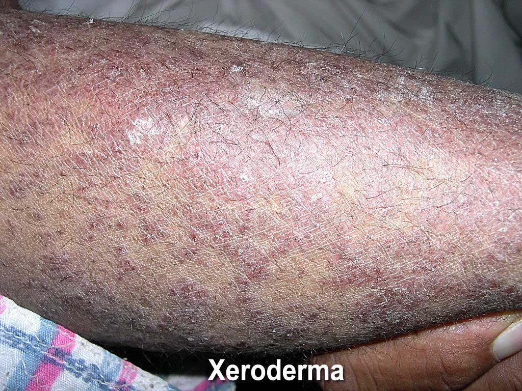 Medical Videos ppt and Lecture Notes Xeroderma