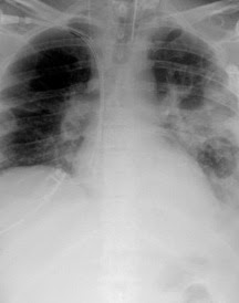 gambar penyakit pneumonia
