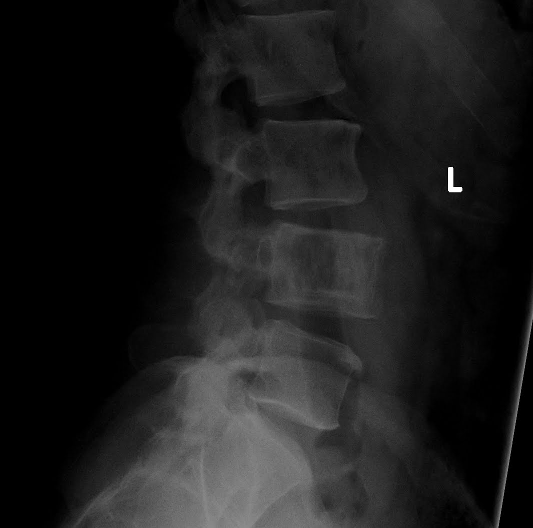 lumbar spine retrolisthesis Grade 1 retrolisthesis lumbar spine scholarly search engine find information about academic papers by weblogrcom grade 1 retrolisthesis lumbar spine. lumbar spine retrolisthesis Grade 1 retrolisthesis lumbar spine scholarly search engine find information about academic papers by weblogrcom grade 1 retrolisthesis lumbar spine.