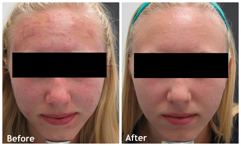 Guelph Medical Laser Before & Afters