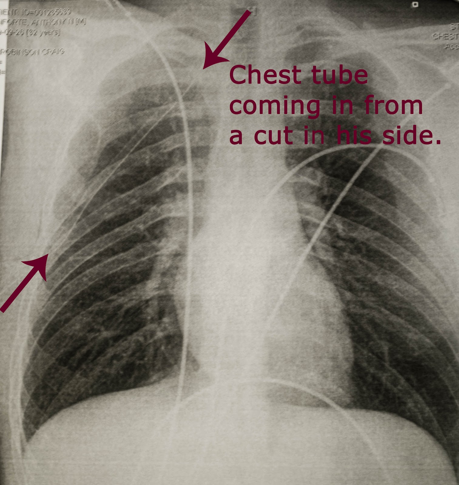 tube chest lung collapsed air days left heidi schatze stayed