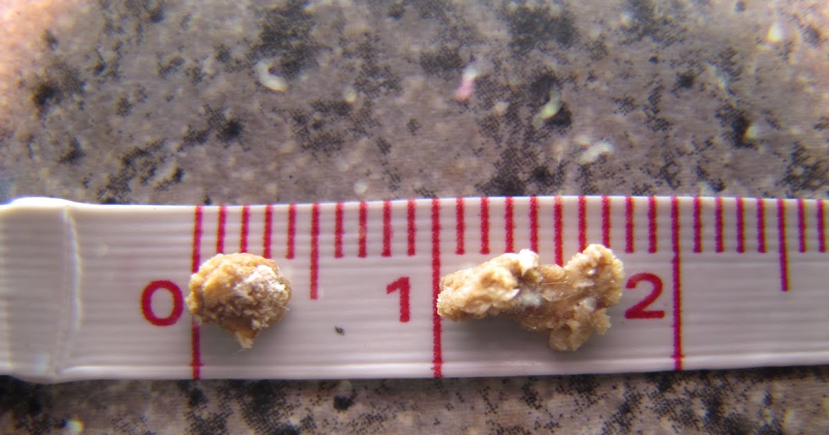 The Haddock's Kidney Stones