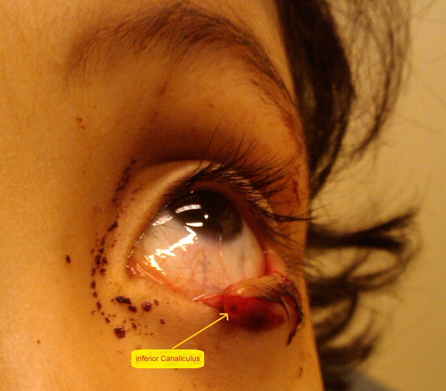 Punctate Inner Choroidopathy