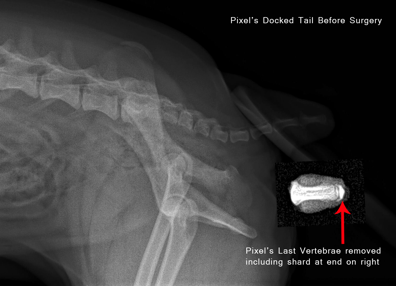dislocated tailbone