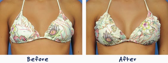 cosmetic surgery breast enhancement Coed naked bowling