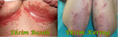 obat eksim di apotik