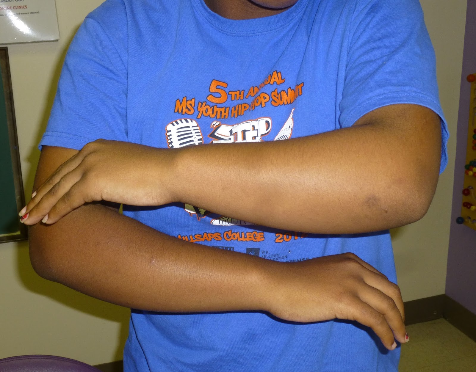 Madelungs Deformity Congenital Hand and Arm Differences Washington University in St. Louis