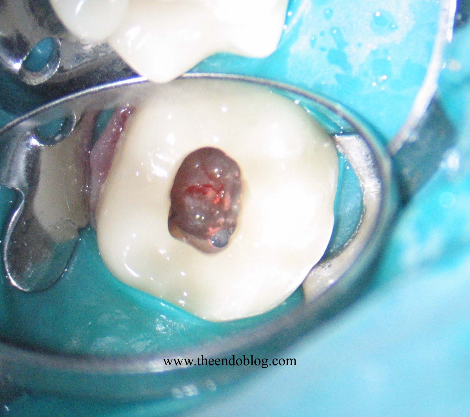 The Endo Blog Microscopes & Management of Root Canal Perforation