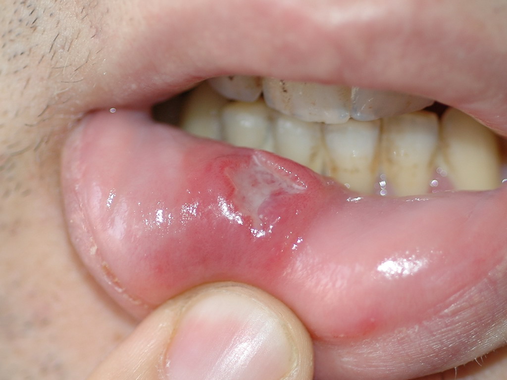 Ulceras+En+El+Pene figura 3 úlcera en labio inferior de gran tamaño en un paciente con ...