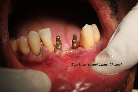 Lower Front Tooth Replacement using dental implants