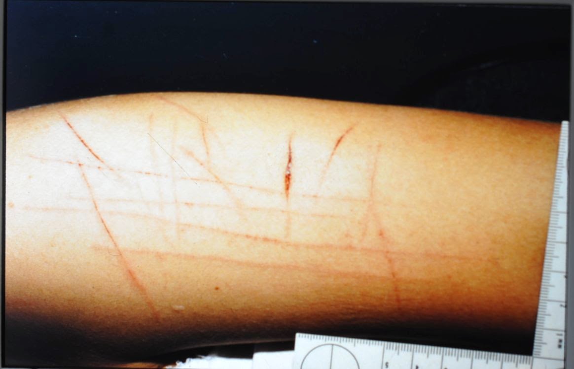 Koronfel's Forensic Medcine Strangulation (manual)