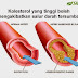 TANDA-TANDA ANDA MENGALAMI KOLESTROL YANG TINGGI