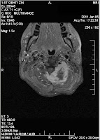 MRI image of skull and neck cervical vertebrae and sarcoma tumor