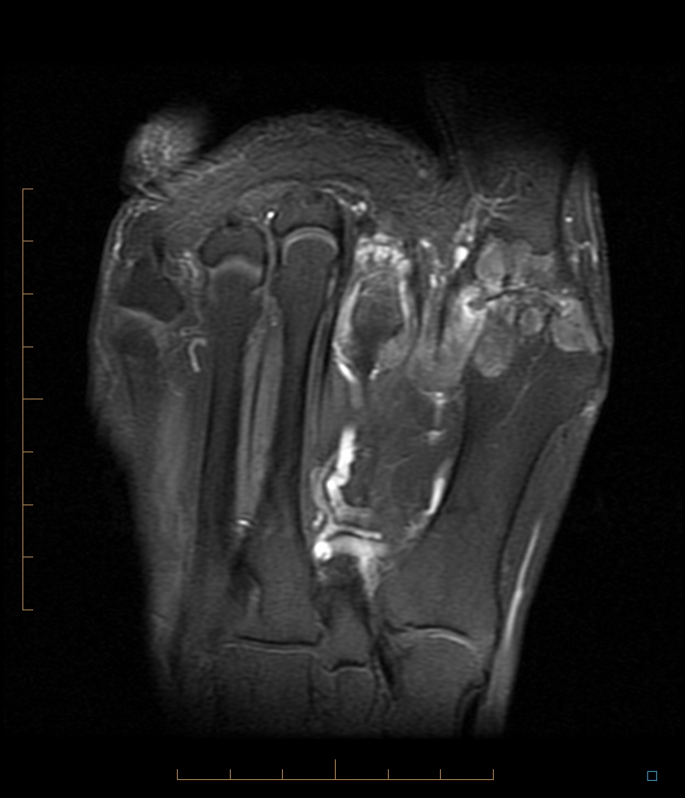 Radiology Cases Gout