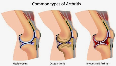 common types of arthritis