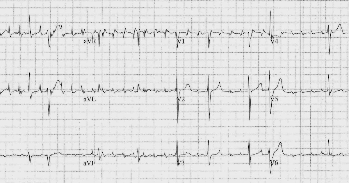 ecg artifact meaning ecg artifact meaning