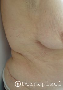 La crema la piel pura de la psoriasis y las dermatitis