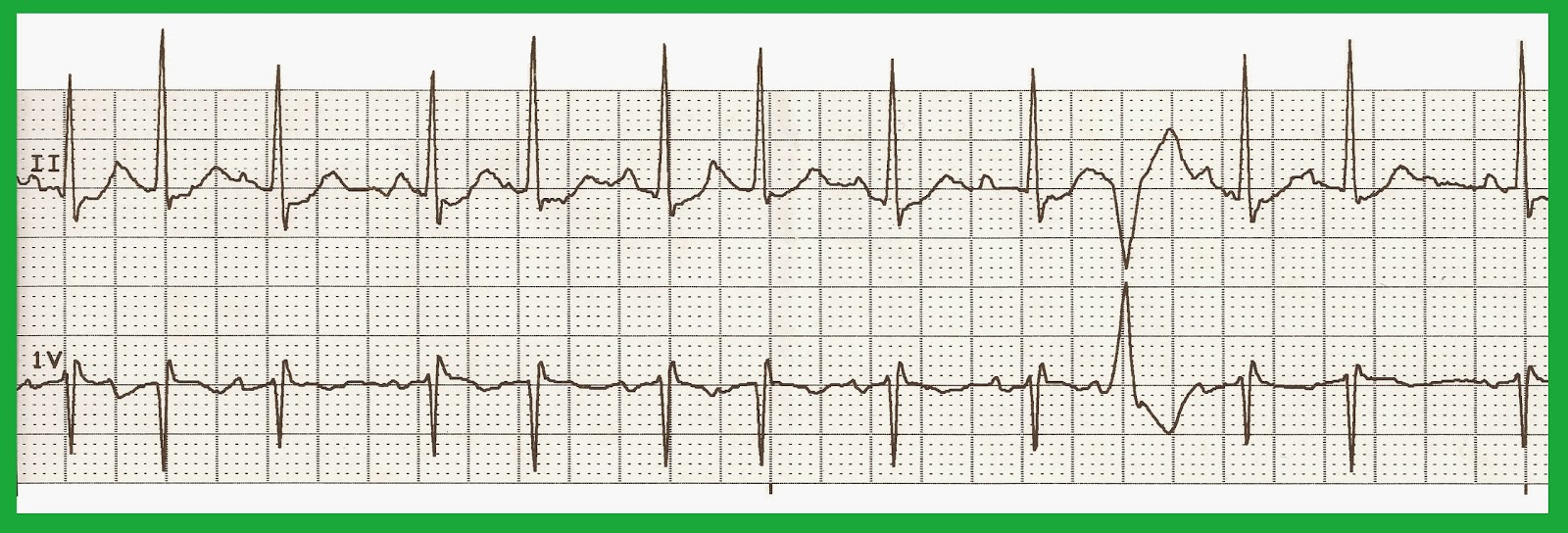 Float Nurse: EKG Rhyth...