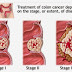 Kanker Payudara Stadium 4 : Kondisi, Ciri-ciri dan Metode Pengobatannya