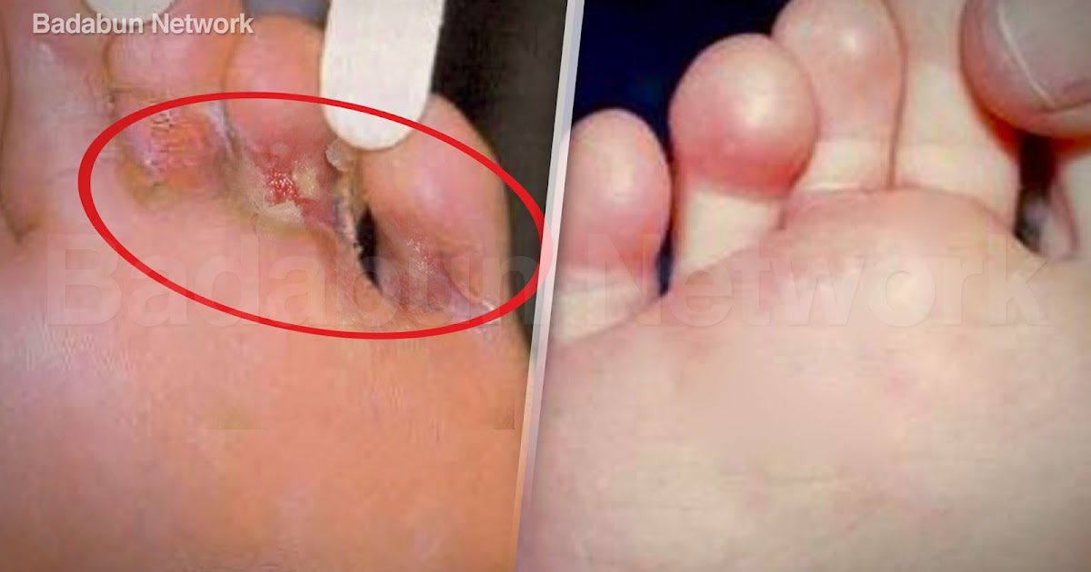 El vídeo por el tratamiento del hongo de las uñas