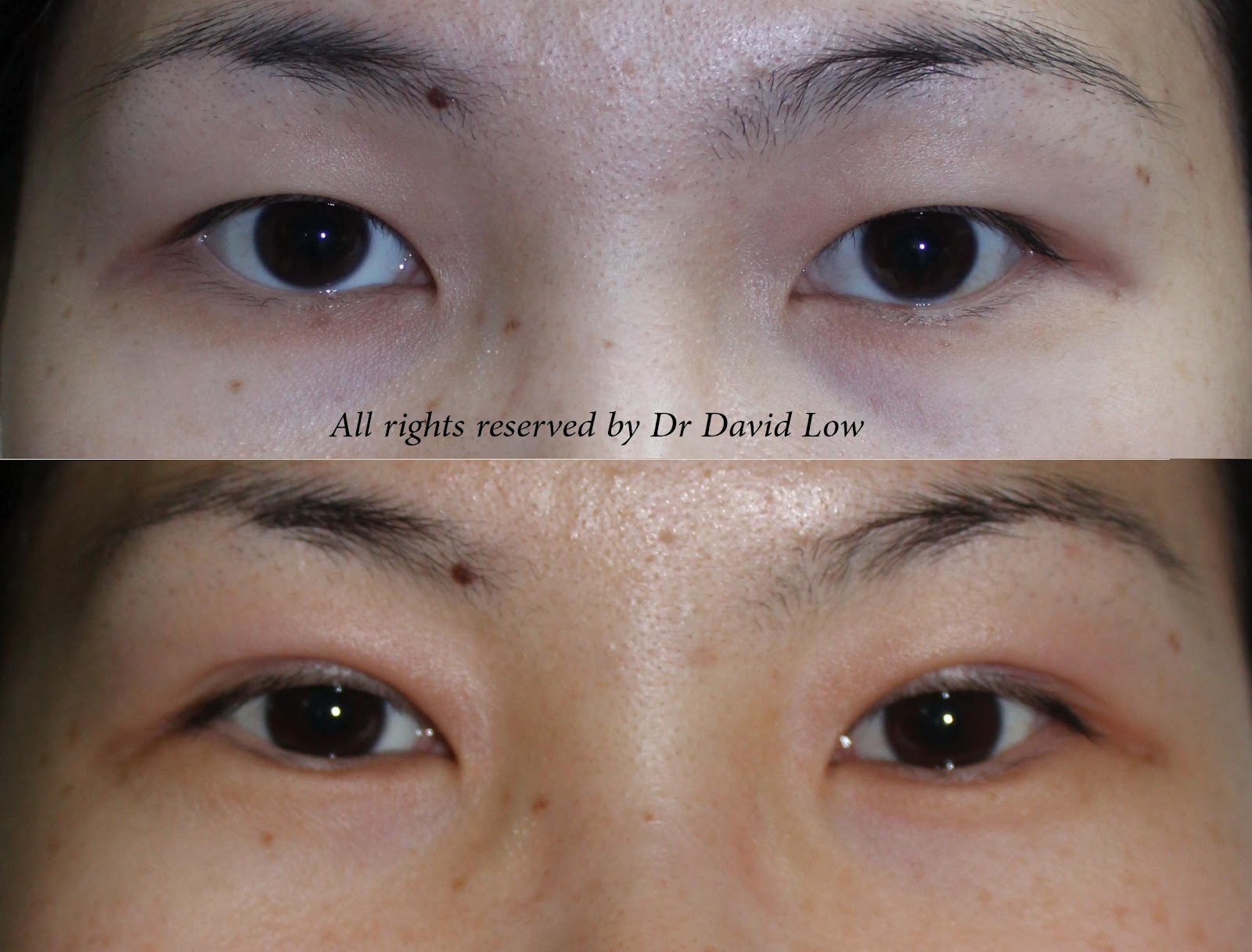 The Art & Science of Beauty Double Eyelid Surgery