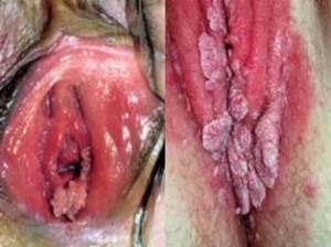 kutil kelamin pada vagina obat tradisional kutil kelamin di vagina