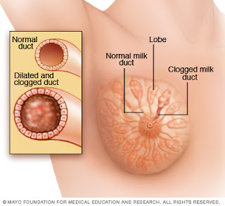 Gambar Jari Jari Fify Menaip Duktus Tersumbat Vs Mastitis Jari Jari Fify Menaip Duktus Tersumbat Vs Mastitis