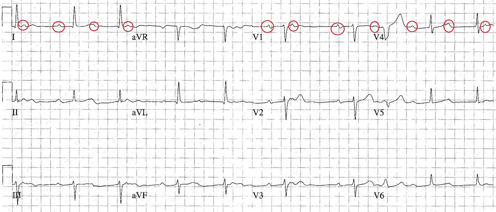 ECG of the Week ECG of the Week 19th October 2015 Interpretation