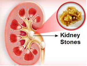 can too much calcium carbonate cause kidney stones