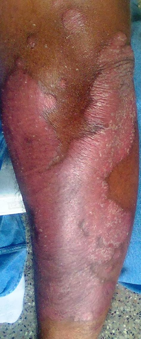 மீன் செதில் படை தோல் நோய் சிறப்பு மருத்துவர் சென்னை