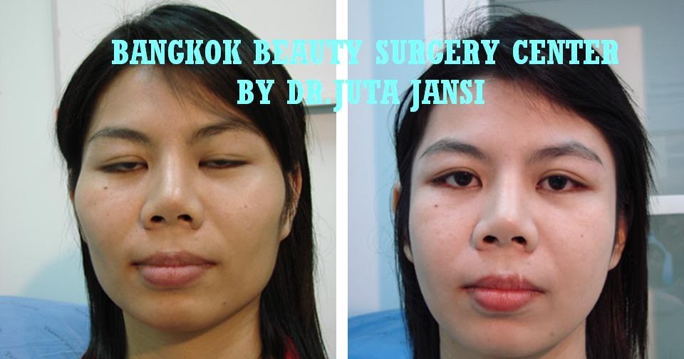 Bangkok Thailand Feminine Surgery