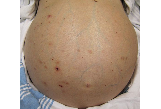 paracentesis