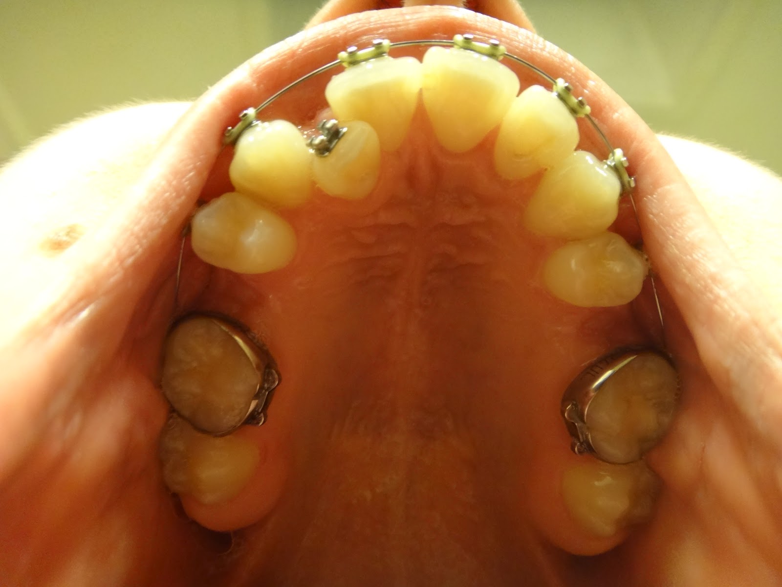 Kelsie's Jaw Surgery First Braces Tightening