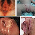 Obat sipilis menurut dokter thumbnail
