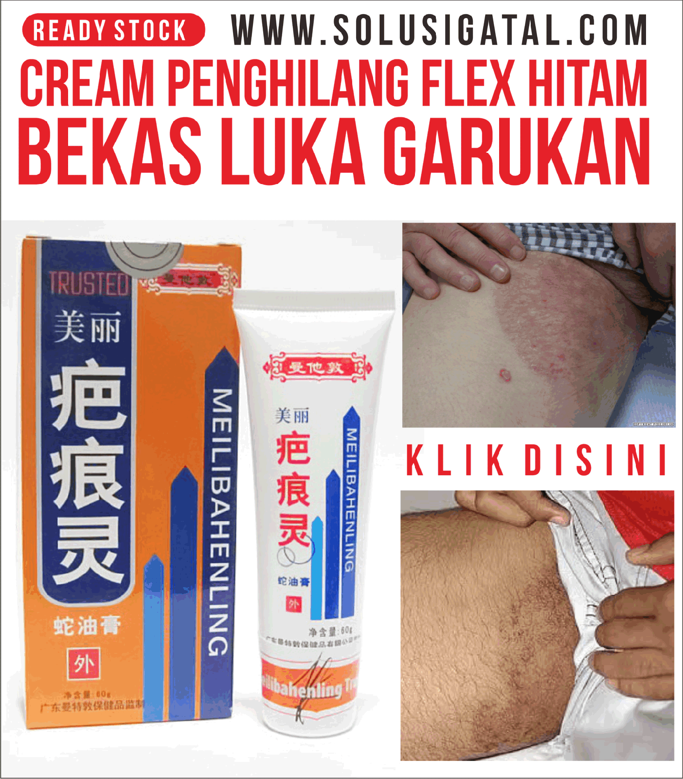 Bolehkah Obat Gatal dan Obat Penghilang Bekas Gatal Dipakai Bersamaan ?