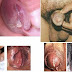 Obat Penis Sakit Apakah Termasuk Sipilis