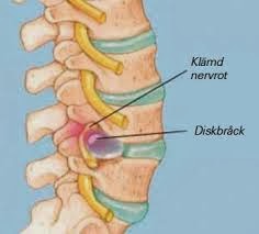 diskbråck i nacken symtom diskbråck i nacken symtom