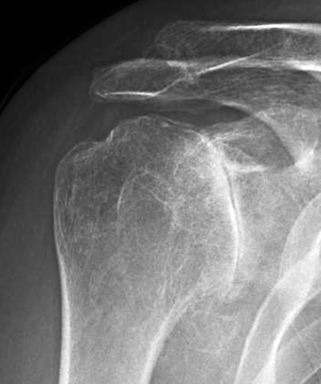Shoulder Arthritis / Rotator Cuff Tears causes of shoulder pain