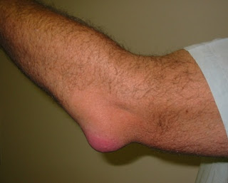 Elbow Bursitis illustrating Swollen Elbow Joint