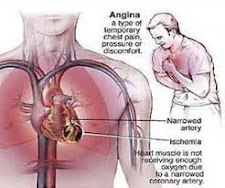 Cara mengobati penyakit jantung