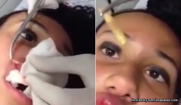 Ngerinya Bila Ulat Bersarang Ditarik Dari Bibir Seorang Gadis! Worm Larvae Pulled From Girls Lips