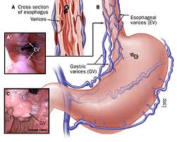 varicose veins in esophagus varicose veins in esophagus