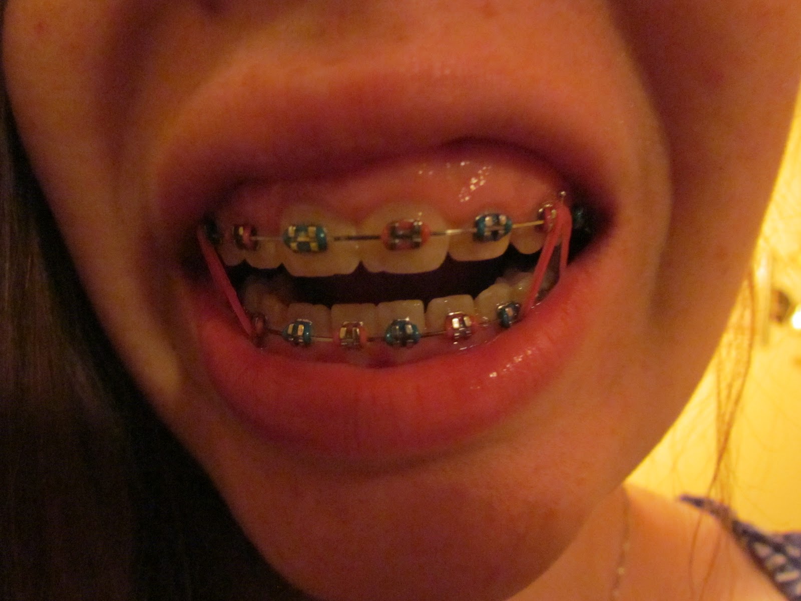 The Melody of Me Braces.... can you relate?